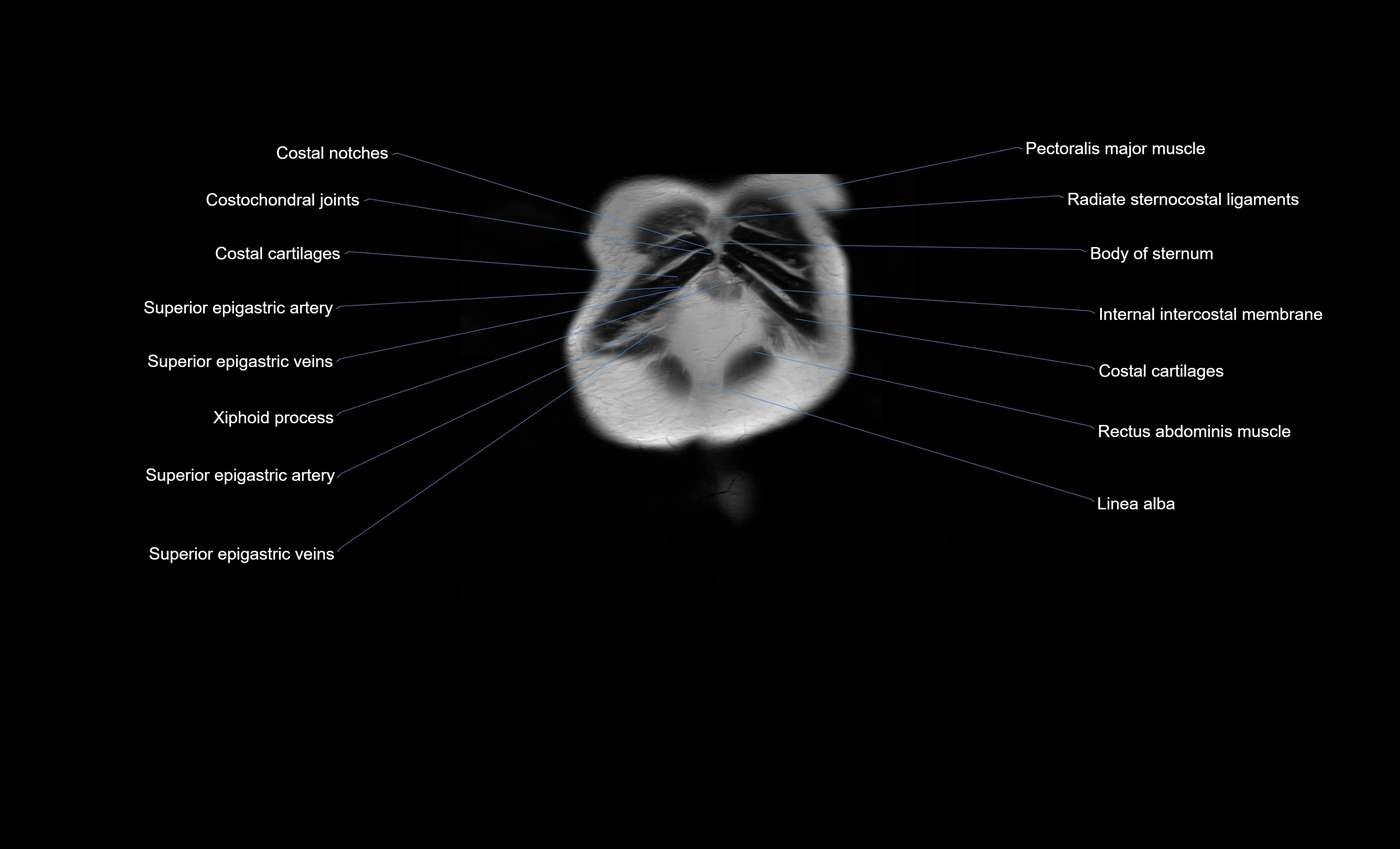MRI Abdomen coronal labelled cross sectional anatomy radiology  image-img-00001-00005.webp